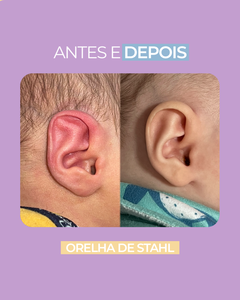 Antes e depois da Orelha de Stahl ou orelha pontuda