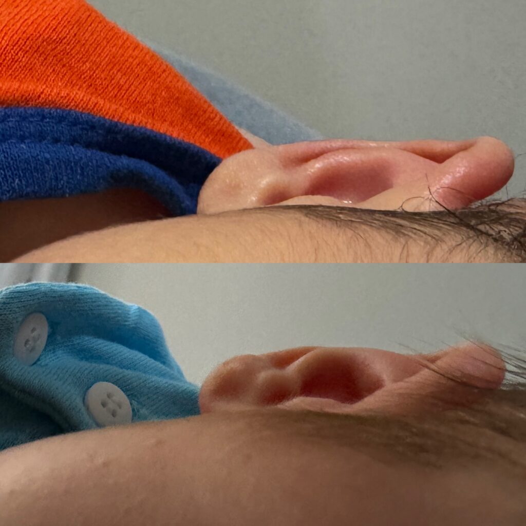 Antes e depois de um bebê com orelhas de abano corrigidas por modelagem de orelhas.