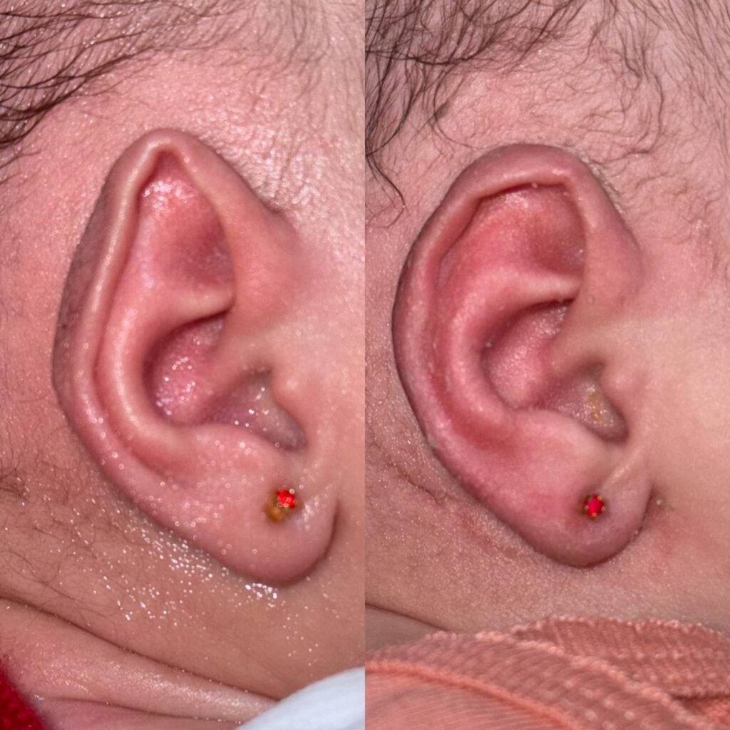 Exemplo de deformidade na orelha do bebê causada por compressão intrauterina, corrigida com modelagem.