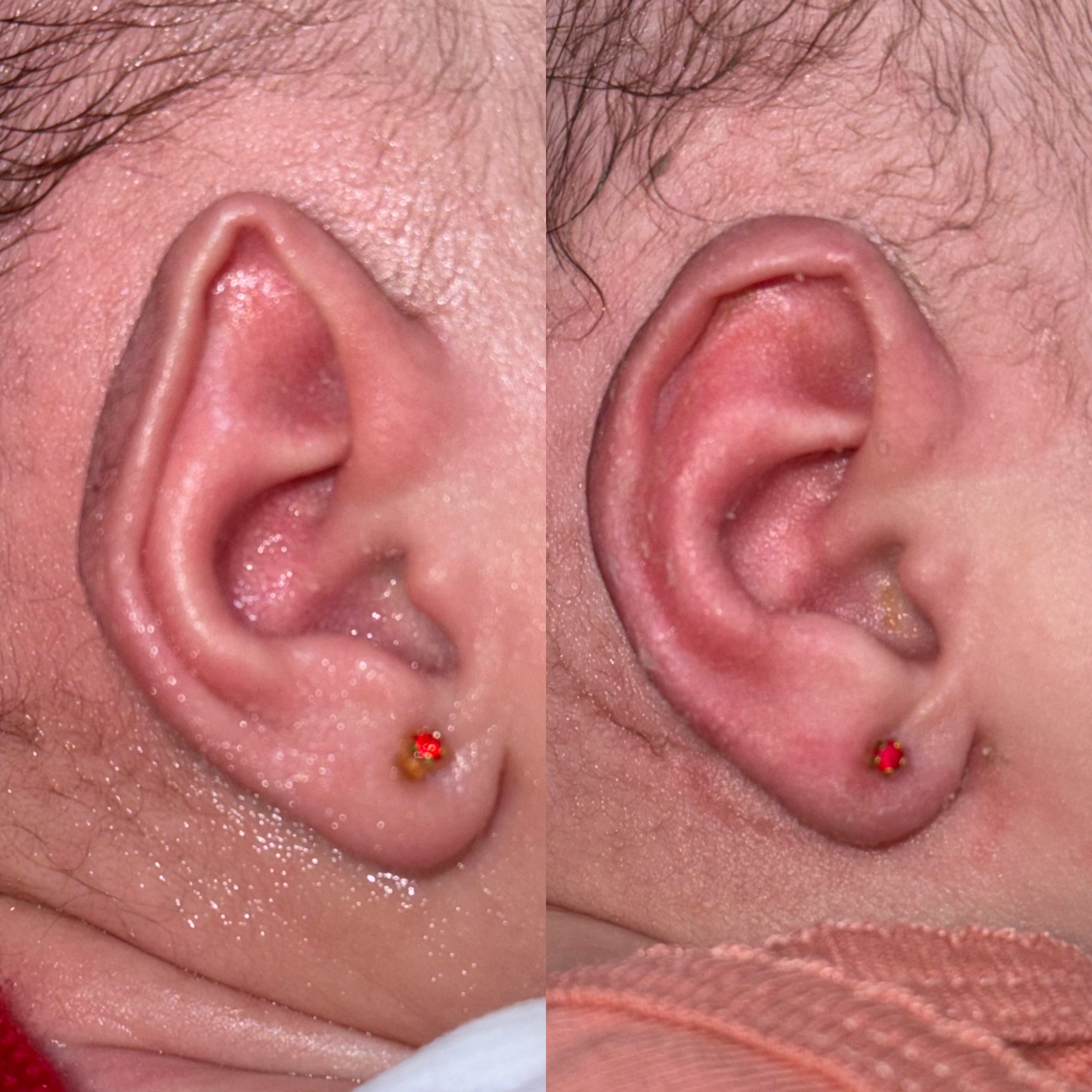Exemplo de deformidade na orelha do bebê causada por compressão intrauterina, corrigida com modelagem.