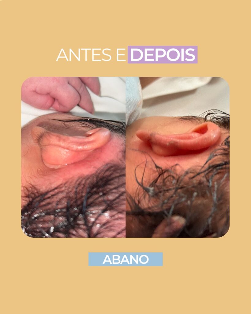 orelha de abano, antes e depois modelagem de orelha